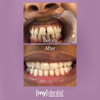 an-amazing-teeth-straightening-result