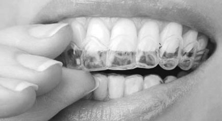 Q removable braces