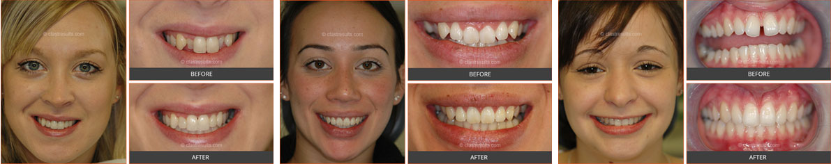 before and after cfast braces