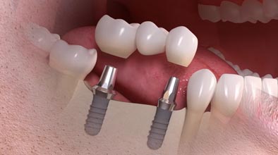 Dental implant bridge video