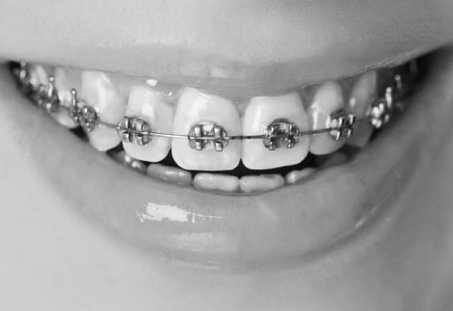 fixed-metal-braces