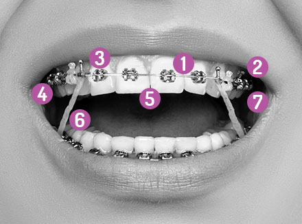 Arch Braces And How They Work