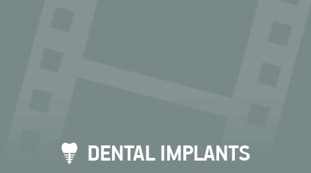 Dental implants by {my}dentist Red Rose Wigan