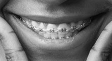 Teen orthodontics