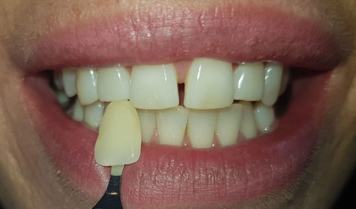 zoom teeth whitening boston