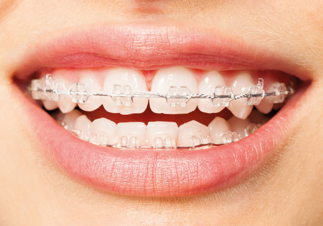 ceramic-braces