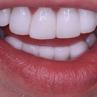 Dental crowns case study 02 after