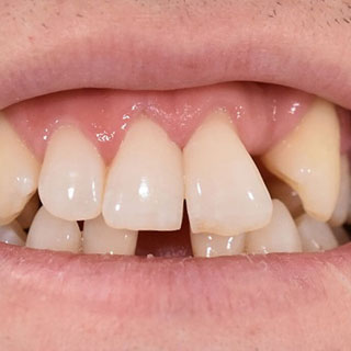 Dental crowns case study 02 before