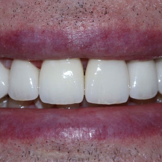 Dental crowns case study 01 after