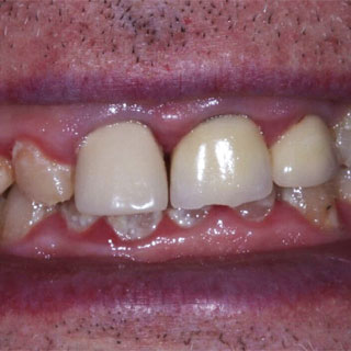 Dental crowns case study 01 before