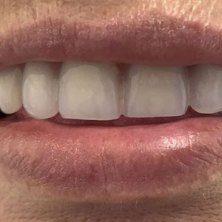 Dentures case 02 after