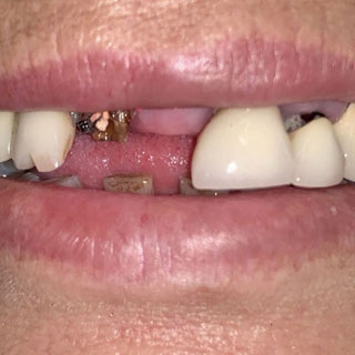 Dentures case 02 before