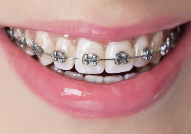 fixed metal braces