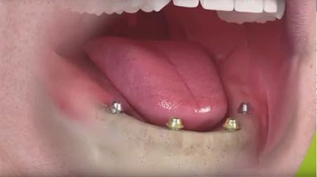 All on four dental implants