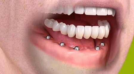 Dental implant bridge and dentures