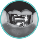 Traditional removable appliance