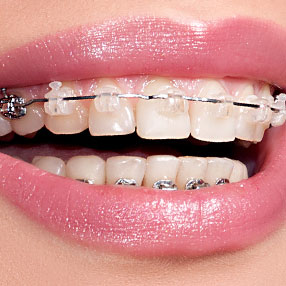 Self-ligating braces