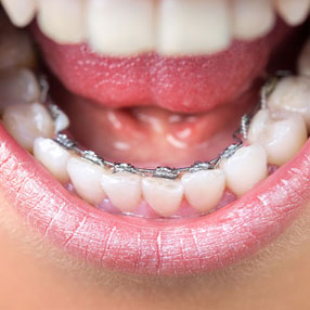 Lingual braces