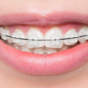 Tooth coloured braces
