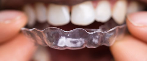 Clear aligners