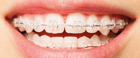 Fixed ceramic braces