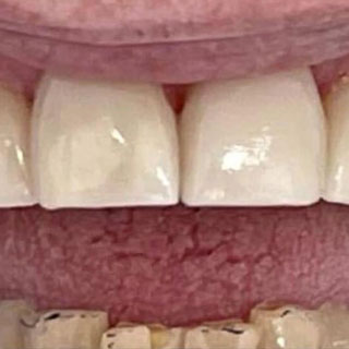 Veneers case study 01 after treatment