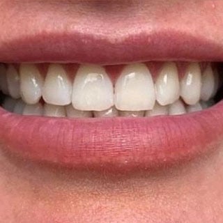 Teeth whitening results after