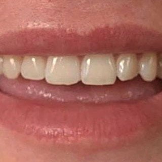 Teeth whitening results before