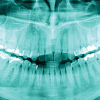 Dental x-rays